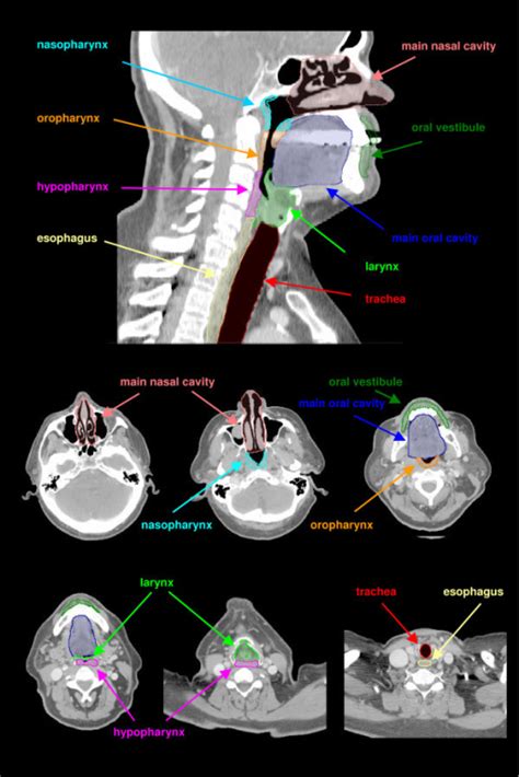 Anatomic Head And Neck Regions Contoured On A Sagittal Open I