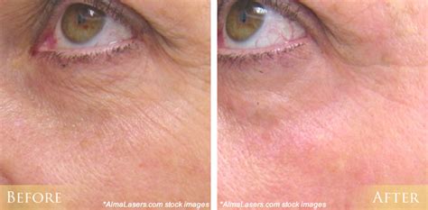 Ipl Photofacial Before And After Pictures Morehead City New Bern Nc