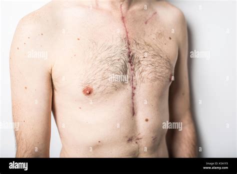 Open Heart Surgery Scar Hi Res Stock Photography And Images Alamy