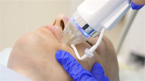 What Is Rf Microneedling Treatment