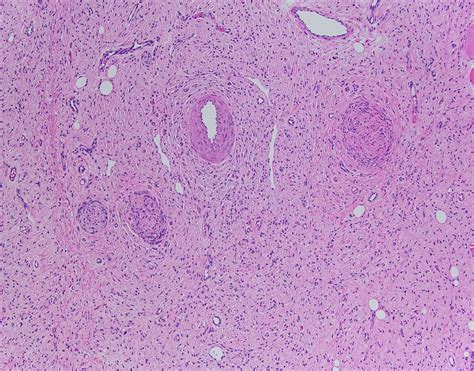 Qiaos Pathology Subcutaneous Neurofibroma A Photo On Flickriver