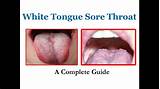 The entire tongue may be coated, or the coating may appear in patches. White Tongue Sore Throat - A Complete Guide - YouTube