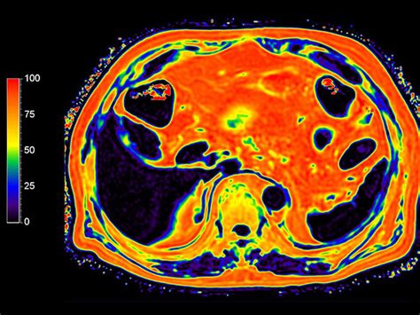 Liver Mr Imaging Philips Mr Body Map