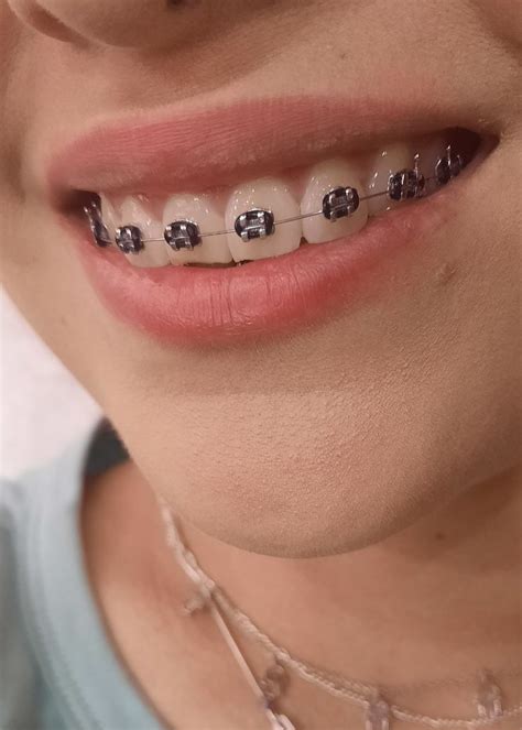 pinterest en 2023 frenillos dentales ligas para brackets dientes con brackets