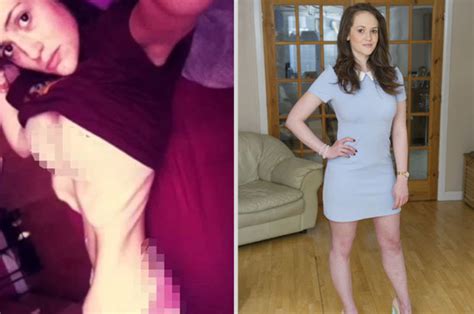 Anorexic Woman Whos Weight Dropped To 4st Makes Amazing Recovery
