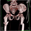 Bilateral Femur Fractures Following an MVA - Musculoskeletal Case ...