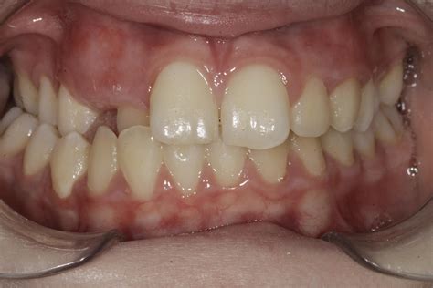 Dental Clinic In Greeceathens Orthodonticsorthodontc Treatment In