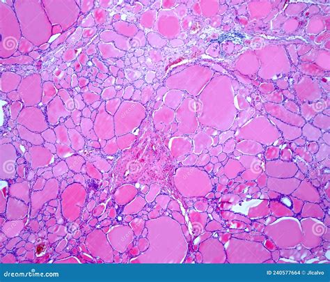 Human Thyroid Gland Diffuse Goiter Stock Photo Image Of Microscopy