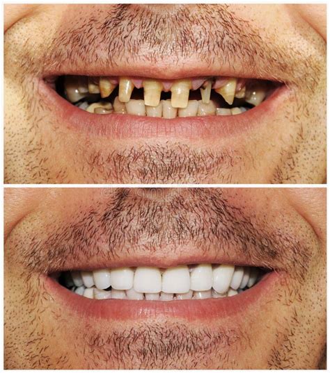 Before And After Picture Of Heathy And Bad Teeth Sponsored Ad