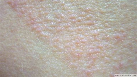 Polymorphous Light Eruptionpmle Pictures And Sun Allergy Rash Images