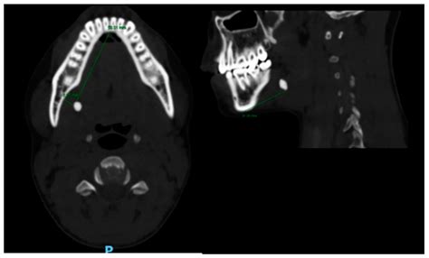 Medicina Free Full Text Sialolithiasis—do Early Diagnosis And