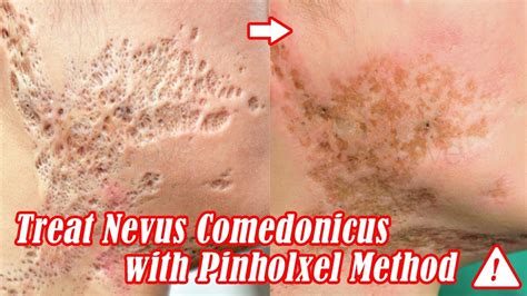 Scar Clinic In Korea Nevus Comedonicus Removal Treatment With