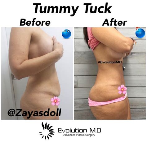 A Tummy Tuck Procedure Can Help Eliminate A Flaccid Stomach This Case