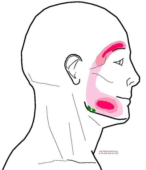 Referral Masseter At Ramus Trigger Points Headache Migraine