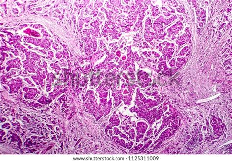 Lymph Node Metastasis Light Micrograph Cancer Stock Photo 1125311009