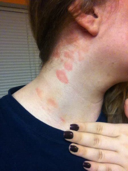Red Splotches On My Neck What Is It Beautylish