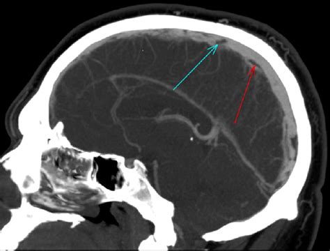 Cureus Cerebral Venous Sinus Thrombosis With Bilateral Abducens Palsy