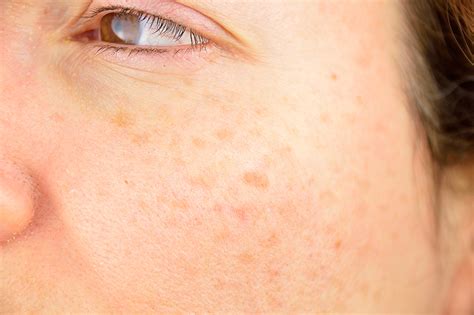 13 Photos Of Skin Spots And What Caused Them Images