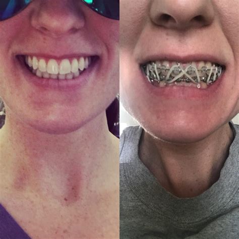 Both Pics Taken This Morningbefore And After My Braces Were Removed After 5 Years And Jaw