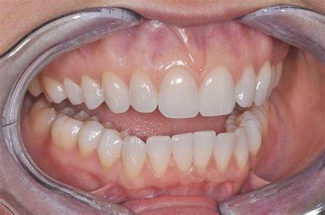 teeth fetish indonesia