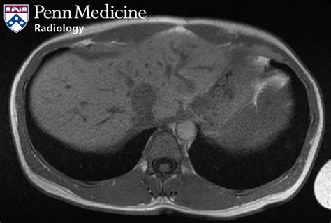 45 Year Old Woman With An Incidental Abdominal Finding Auntminnie