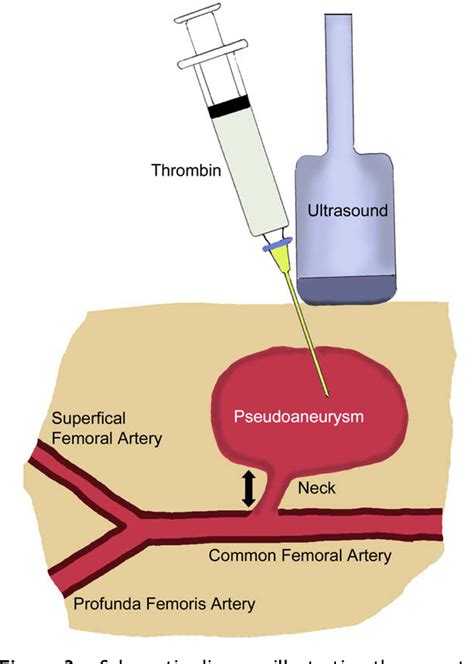 Figure 3 From Iatrogenic Femoral Artery Pseudoaneurysms A Review Of