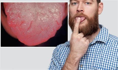 B12 Deficiency Symptoms Include Smooth Tongue Uk