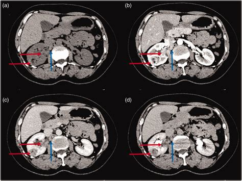 Sporadic Multiple Renal Angiomyolipoma With Lymph Node Involvement A