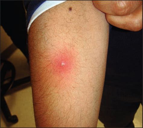 You may have heard mrsa called a superbug. images of mrsa skin infections - pictures, photos