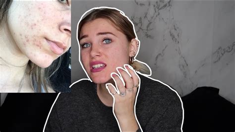 How My Acne Cleared Up Youtube