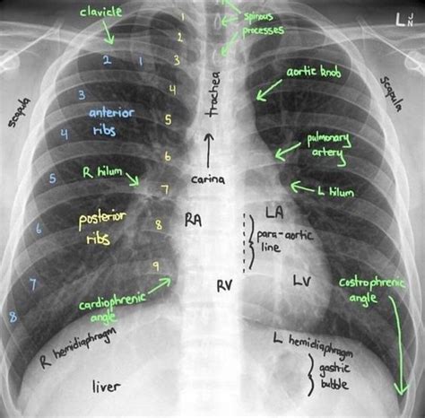 Tips On How To Get The Perfect Pa Chest X Ray Ask The Rad Tech