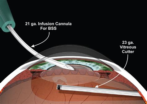 Managing A Posterior Capsular Break