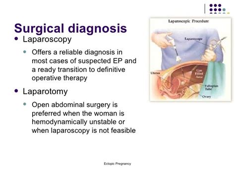 Ectopic Pregnancy