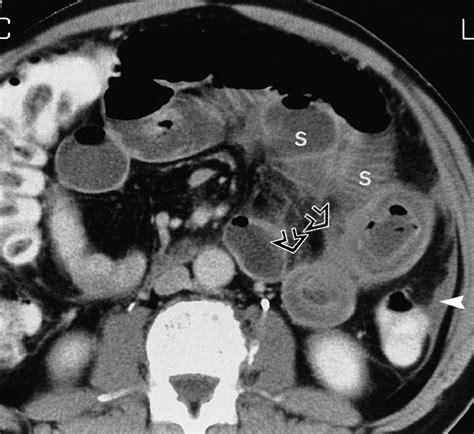 Ct Evaluation Of Small Bowel Obstruction Radiographics