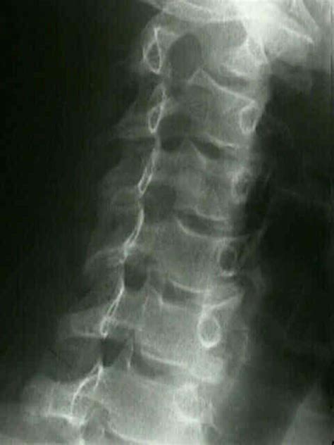 Oblique View Of C Spine Wheeless Textbook Of Orthopaedics