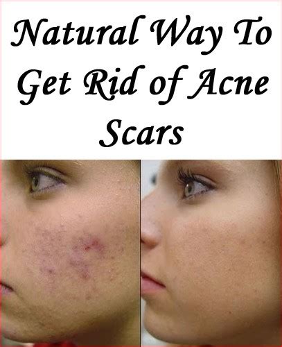 How To Get Rid Of Acne Scars Naturally With Home Remedies By