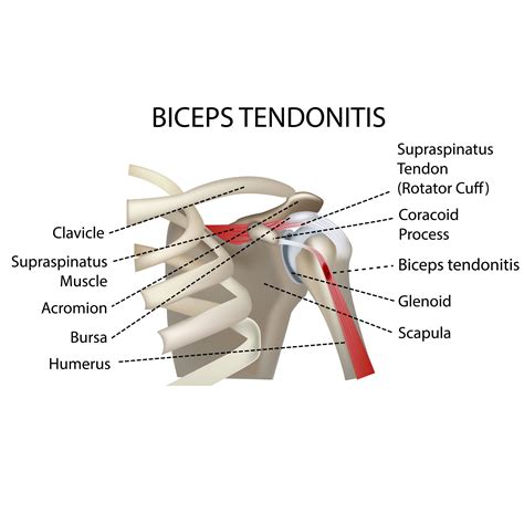 130 Biceps Tendonitis Ideas Tendinitis Biceps Bicep Tendonitis Images