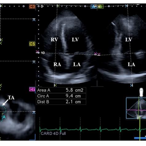 M Mode Echocardiography Derived Assessment Of Tricuspid Annular Plane