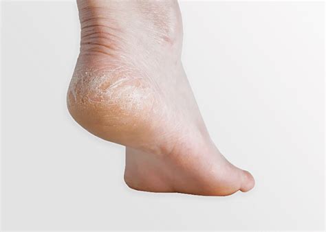 Dry Feet Causes And Treatment Fastlyheal