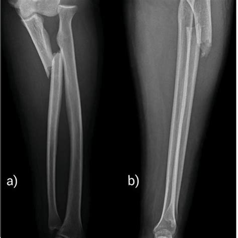 Full Length Anteroposterior A And Lateral B Radiographs Of Left