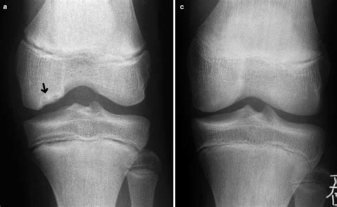 Pediatric And Adolescent Disorders Of The Knee Radiology Key
