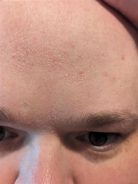 Dryflakyscaly Forehead Rdermatologyquestions