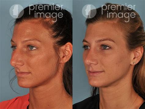 Rhinoplasty Before And After Sandy Springs Ga Patient 16059