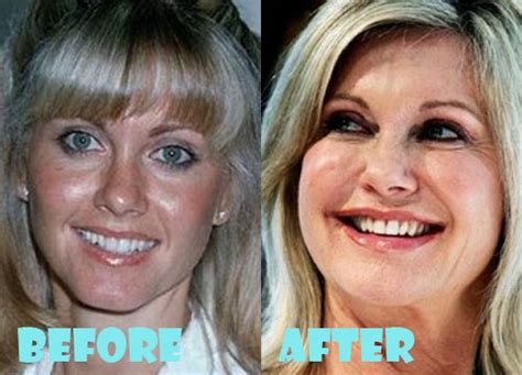 Olivia Newton John Plastic Surgery Before And After Pictures Lovely