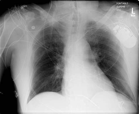 CXR Misplaced NG Tube MD Nexus