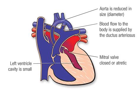 Single Ventricle Defects American Heart Association