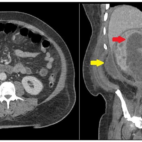 Initial Ct Showing Renal Red Arrow And Perihepatic Abscesses Yellow