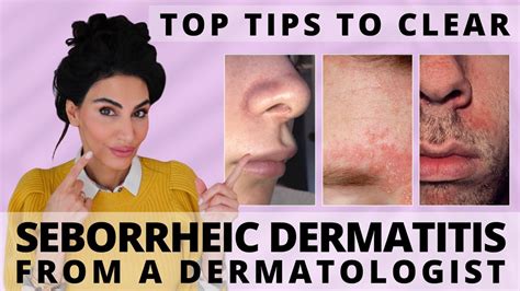 Top Tips To Clear Seborrheic Dermatitis Dermatologist Deep Dive YouTube
