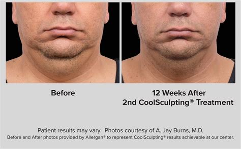 Dr Sculpt® Before And After Pictures