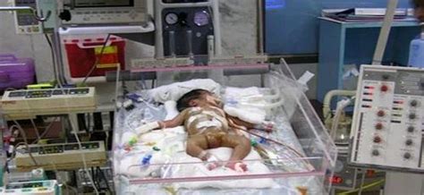 Neonatal Surgeries In India